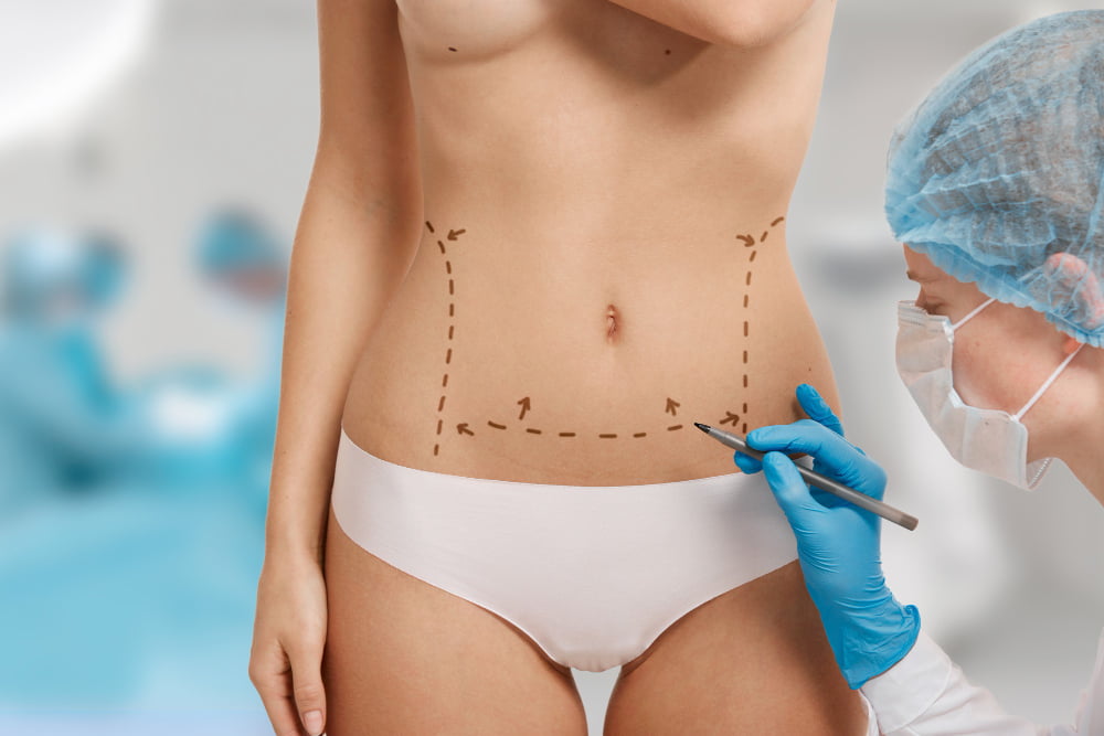 Gordura localizada nas costas: o que fazer 4 cirurgia plastica
